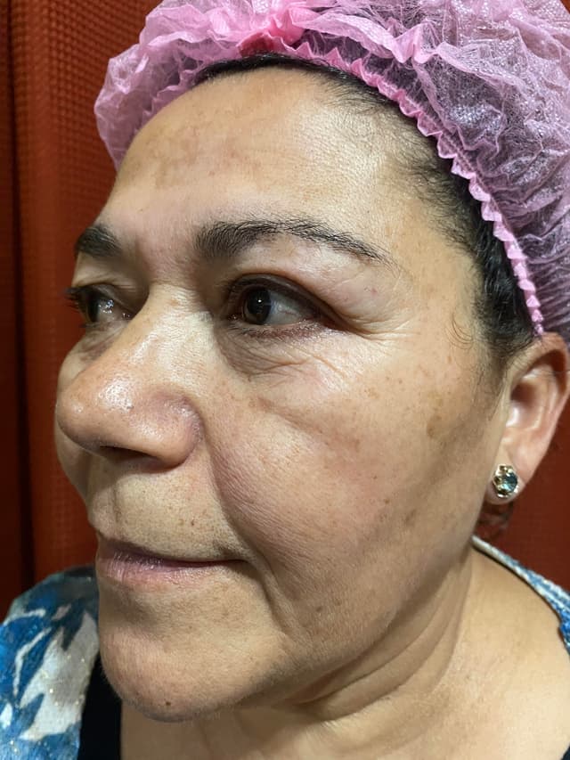 Antes - Dermaplaning