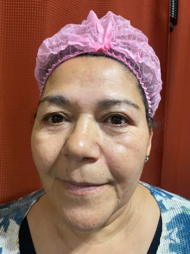 Antes - Dermaplaning