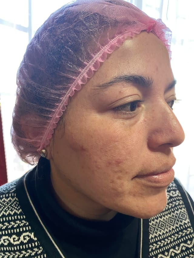 Antes - Dermaplaning