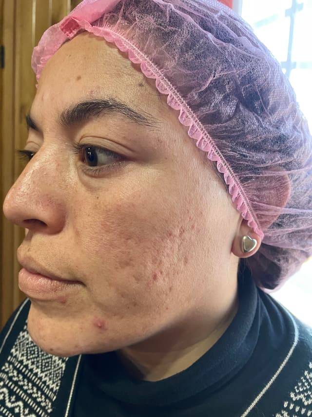 Antes - Dermaplaning