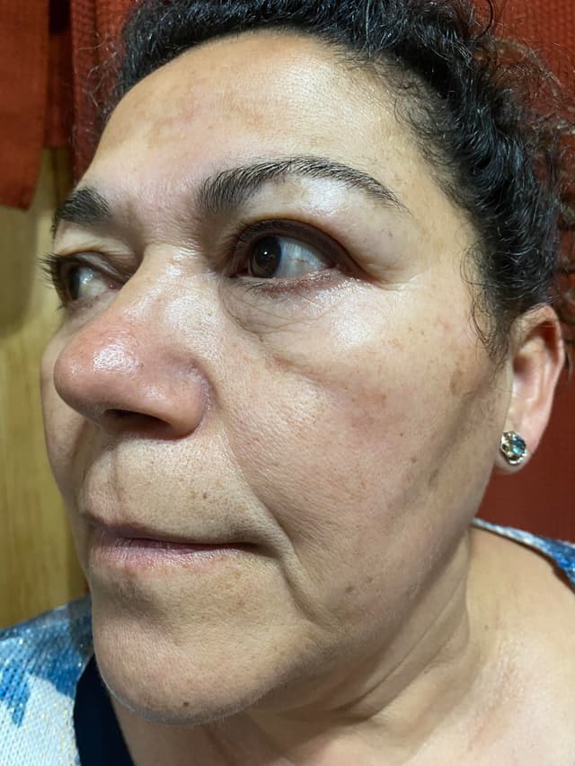 Antes - Dermaplaning