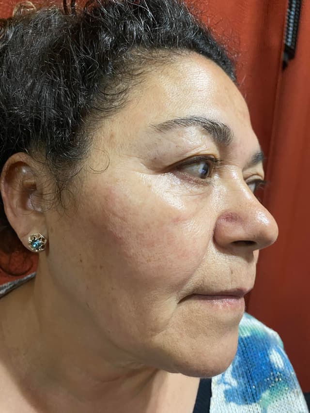 Antes - Dermaplaning