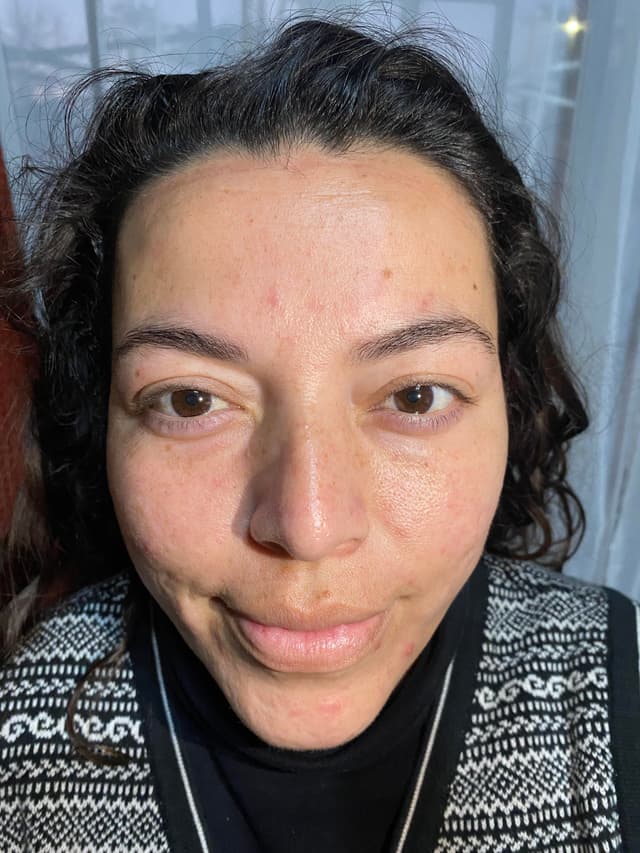 Antes - Dermaplaning