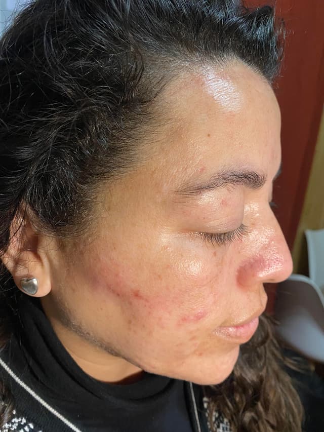 Antes - Dermaplaning