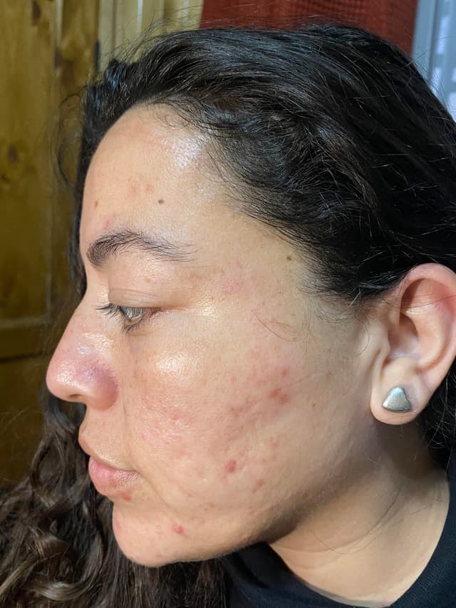 Antes - Dermaplaning